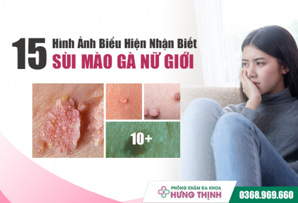 15 Hình Ảnh Biểu Hiện Nhận Biết Sùi Mào Gà Nữ Giới, Nguyên Nhân Và Cách Điều Trị