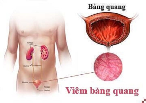 Triệu chứng của viêm bàng quang mà người bệnh cần lưu ý