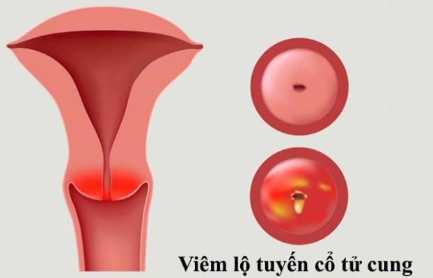 Viêm Lộ Tuyến Cổ Tử Cung Và Những Cảnh Báo Không Thể Bỏ Qua