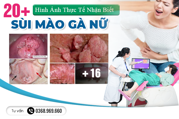 20+ Hình Ảnh Thực Tế Nhận Biết Biểu Hiện Sùi Mào Gà Nữ Và Các Vị Trí Thường Gặp