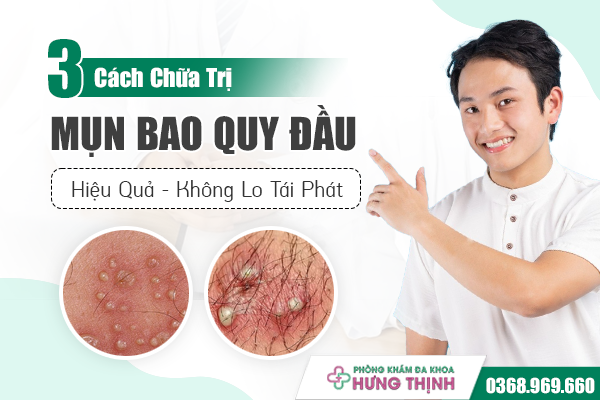 3 Cách Chữa Trị Mụn Bao Quy Đầu Hiệu Quả, Không Lo Tái Phát