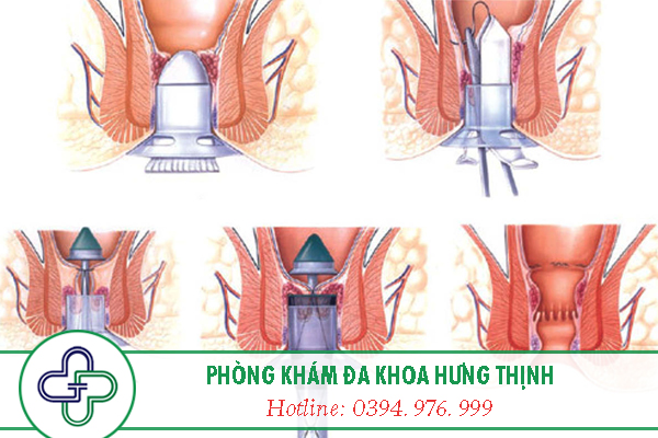 Cách chữa bệnh rò hậu môn an toàn