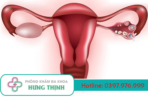 Phương pháp điều trị viêm buồng trứng