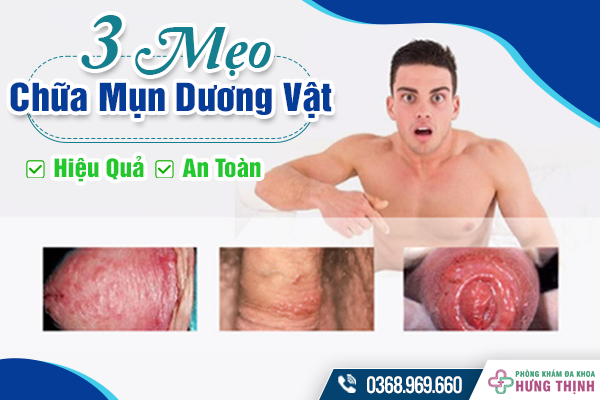 3 Mẹo Chữa Trị Mụn Dương Vật Hiệu Quả Và An Toàn