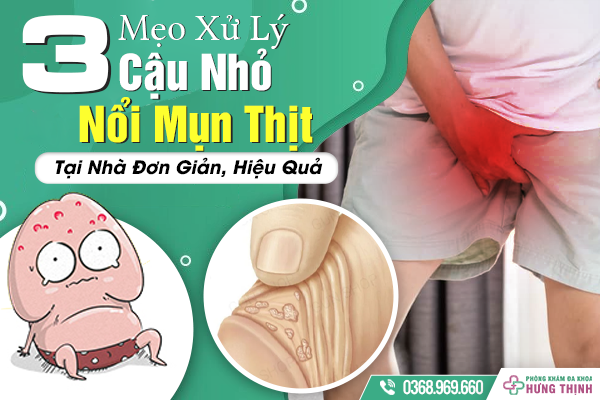 3 Mẹo Xử Lý Cậu Nhỏ Nổi Mụn Thịt Tại Nhà Đơn Giản, Hiệu Quả