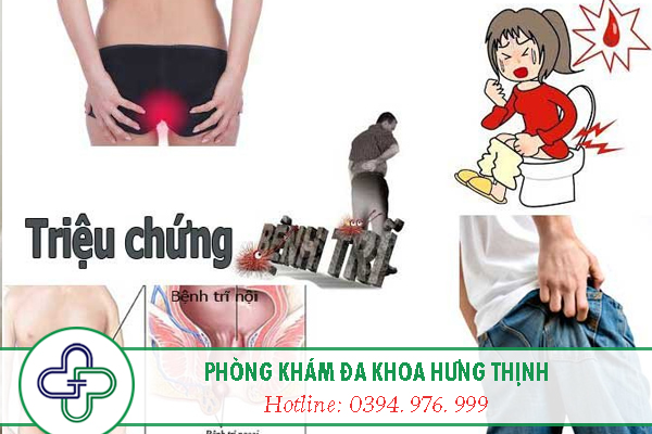 Dấu hiệu nhận biết bệnh trĩ nội