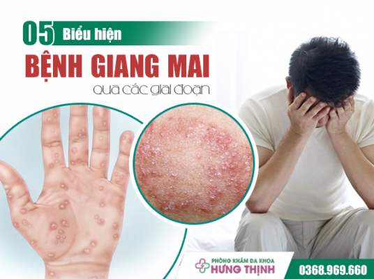 5 Biểu Hiện Bệnh Giang Mai Qua Các Giai Đoạn