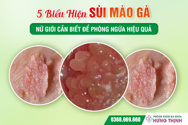 5 Biểu Hiện Sùi Mào Gà Nữ Giới Cần Biết Để Phòng Ngừa Hiệu Quả