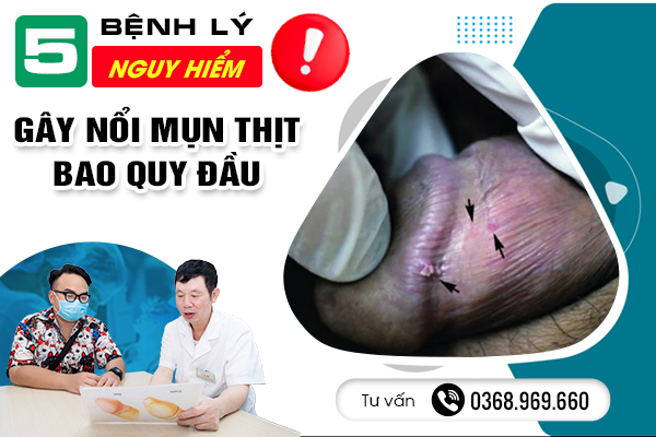 5 Bệnh Lý Nguy Hiểm Gây Nổi Mụn Thịt Bao Quy Đầu Cần Đi Khám Ngay