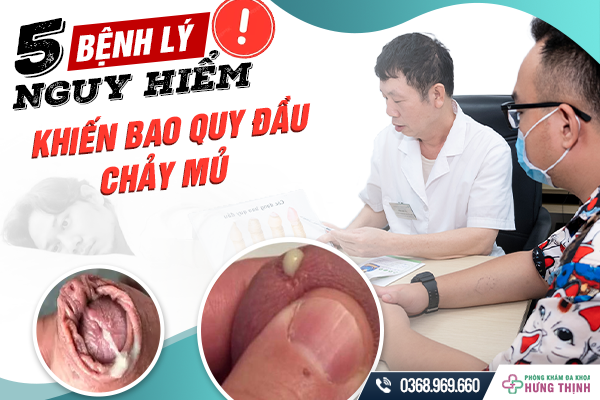 5 Bệnh Lý Nguy Hiểm Khiến Bao Quy Đầu Chảy Mủ Nam Giới Cần Khắc Phục Ngay