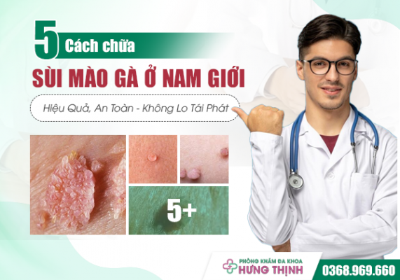  5 Cách Chữa Sùi Mào Gà Ở Nam Giới Hiệu Quả, An Toàn - Loại Bỏ Mụn Sùi, Không Lo Tái Phát