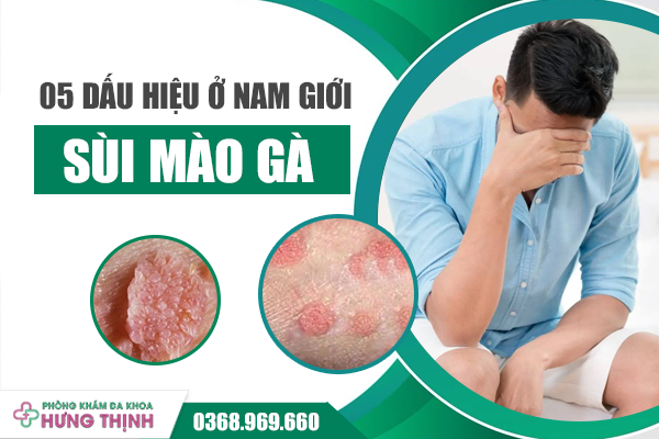 5 Dấu Hiệu Nhận Biết Bệnh Sùi Mào Gà Ở Nam Giới