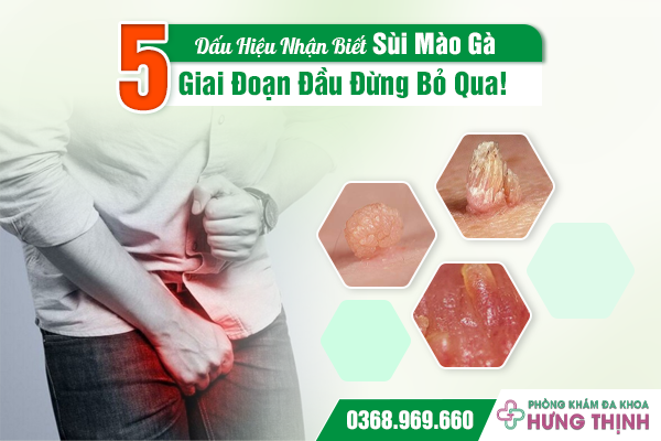 5 Dấu Hiệu Nhận Biết Sùi Mào Gà Giai Đoạn Đầu Đừng Bỏ Qua!