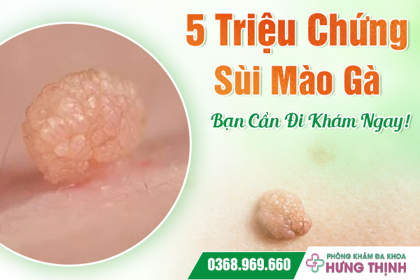 5 Triệu Chứng Sùi Mào Gà Bạn Cần Đi Khám Ngay!