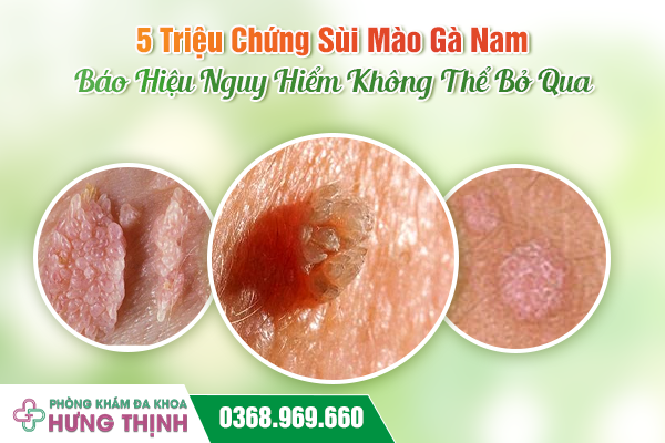 5 Triệu Chứng Sùi Mào Gà Nam Báo Hiệu Nguy Hiểm Không Thể Bỏ Qua