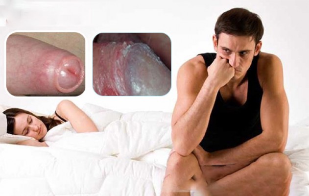 Dương vật bị ngứa, tróc da có sao không? Những cách điều trị hiệu quả