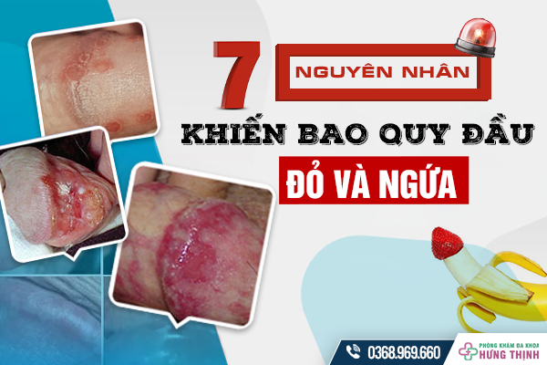 7 Nguyên Nhân Khiến Bao Quy Đầu Đỏ Và Ngứa, Cảnh Báo Bệnh Lý Nguy Hiểm