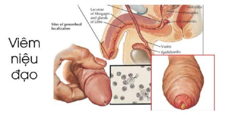 Biểu Hiện Viêm Niệu Đạo Nam