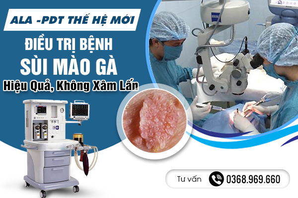 ALA -PDT Thế Hệ Mới Phương Pháp Điều Trị Bệnh Sùi Mào Gà Hiệu Quả, Không Xâm Lấn