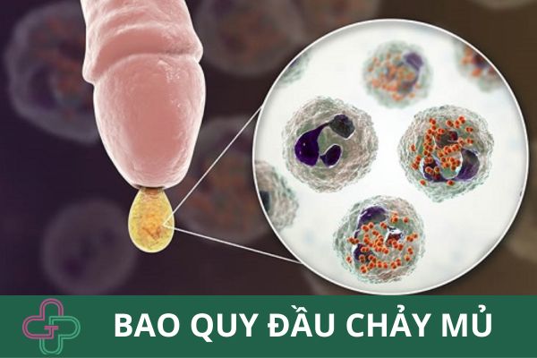 Bao quy đầu chảy mủ- đừng chủ quan