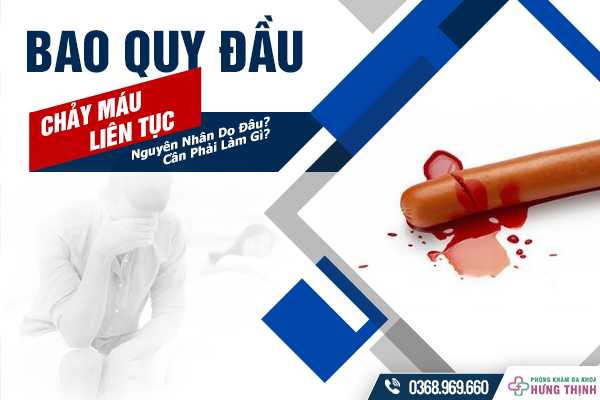 Bao Quy Đầu Chảy Máu Liên Tục Nguyên Nhân Do Đâu? Cần Phải Làm Gì?