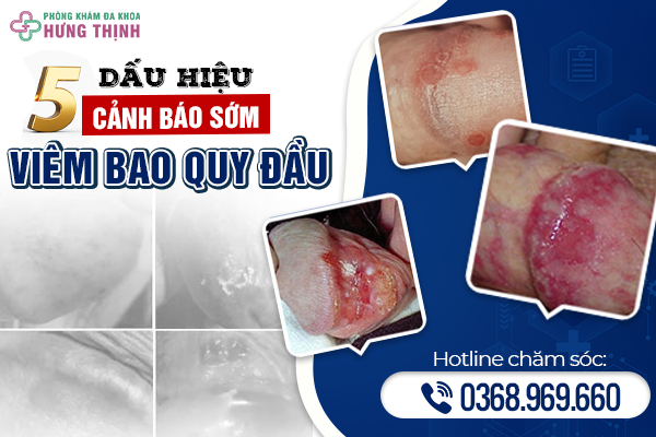 Bạn Có Nhận Ra 5 Dấu Hiệu Cảnh Báo Sớm Của Bệnh Viêm Bao Quy Đầu Ở Nam Giới?