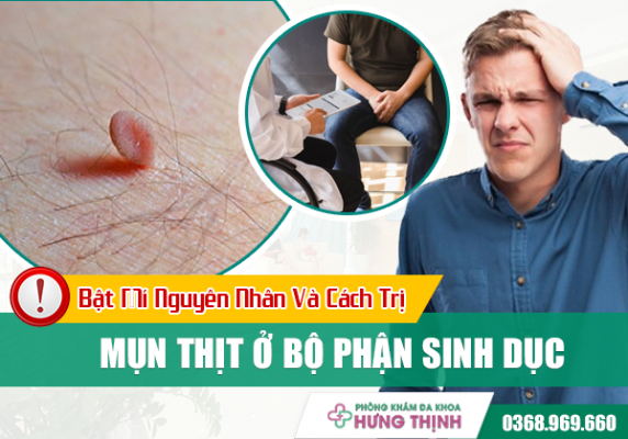 Bật Mí Nguyên Nhân Và Cách Trị Mụn Thịt Ở Bộ Phận Sinh Dục 