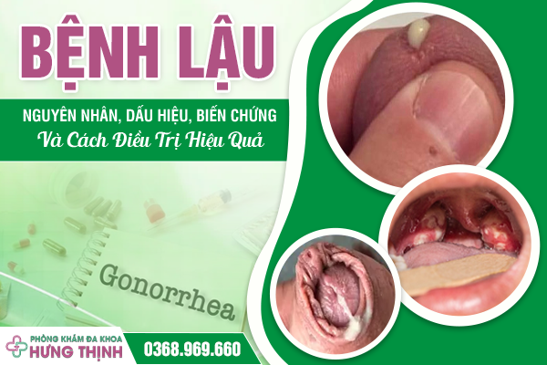 Bệnh Lậu: Nguyên Nhân, Dấu Hiệu, Biến Chứng Và Cách Điều Trị Hiệu Quả