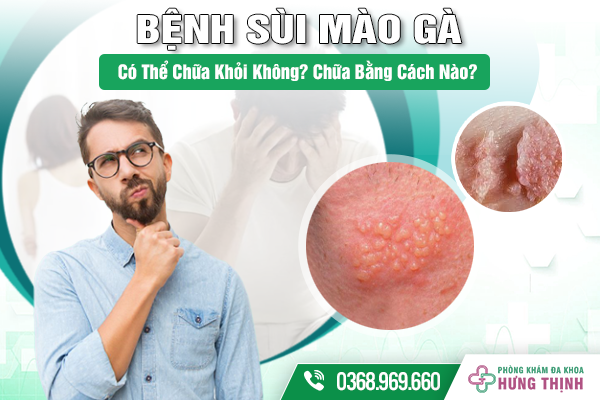 Bệnh Sùi Mào Gà Có Thể Chữa Khỏi Không? Chữa Bằng Cách Nào?