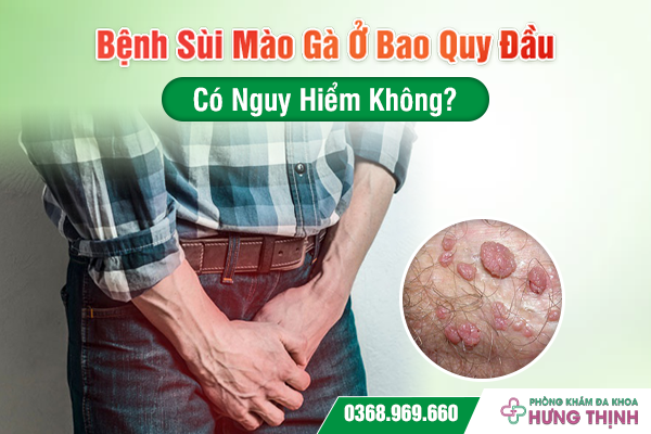 Bệnh Sùi Mào Gà Ở Bao Quy Đầu Có Nguy Hiểm Không?