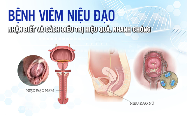 Bệnh Viêm Niệu Đạo: Nhận Biết Và Cách Điều Trị Hiệu Quả, Nhanh Chóng