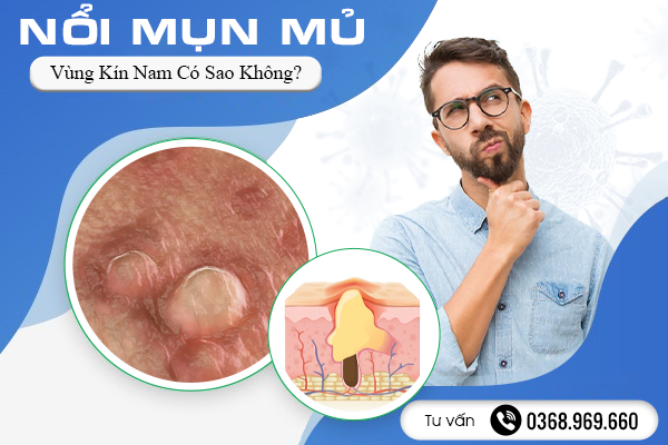 Bị Nổi Mụn Mủ Ở Vùng Kín Nam Có Sao Không? Nguyên Nhân Và Cách Phòng Tránh Hiệu Quả