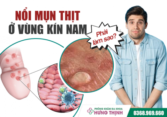 Bị Nổi Mụn Thịt Ở Vùng Kín Nam Phải Làm Sao?