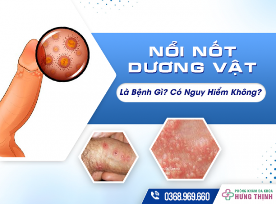 Bị Nổi Nốt Dương Vật Là Bệnh Gì? Có Nguy Hiểm Không?