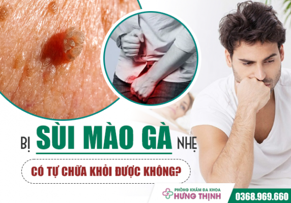 Bị Sùi Mào Gà Nhẹ Có Tự Chữa Khỏi Được Không?