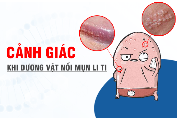 Cảnh Giác Khi Dương Vật Nổi Mụn Li Ti