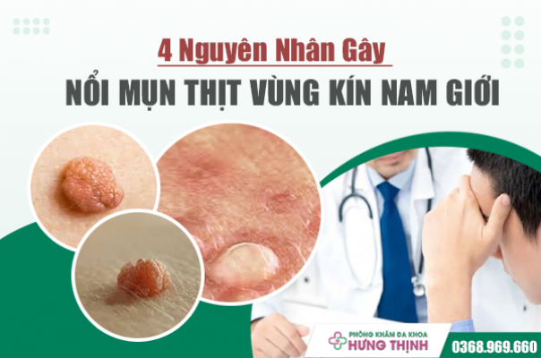 [Cẩn Trọng] 4 Nguyên Nhân Gây Nổi Mụn Thịt Vùng Kín Nam Giới 