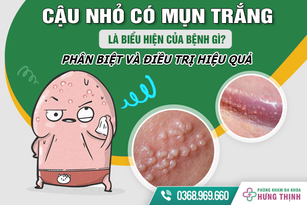 Cậu Nhỏ Có Mụn Trắng Là Biểu Hiện Của Bệnh Gì? Phân Biệt Và Điều Trị Hiệu Quả