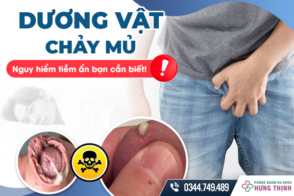 Cảnh báo: Dương vật chảy mủ - Nguy hiểm tiềm ẩn bạn cần biết!