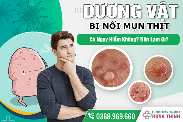  Dương Vật Bị Nổi Mụn Thịt Có Nguy Hiểm Không? Nên Làm Gì?