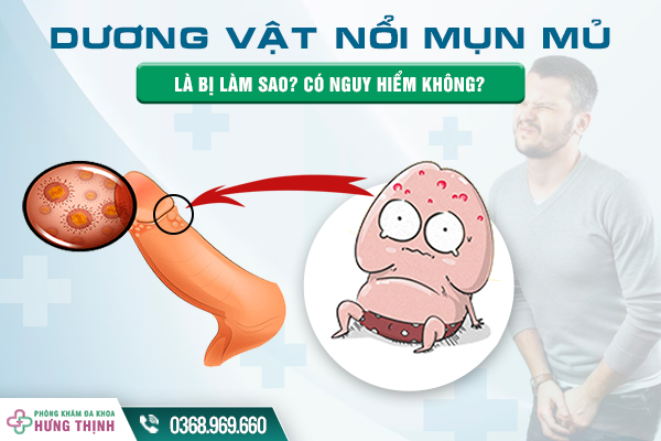 Dương Vật Nổi Mụn Mủ Là Bị Làm Sao? Có Nguy Hiểm Không?