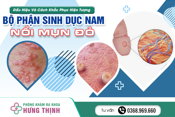 Dấu Hiệu Và Cách Khắc Phục Hiện Tượng Bộ Phận Sinh Dục Nam Nổi Mụn Đỏ