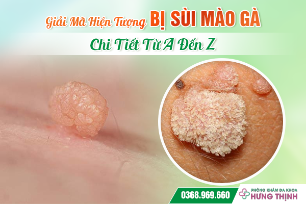 Giải Mã Hiện Tượng Bị Sùi Mào Gà Chi Tiết Từ A Đến Z