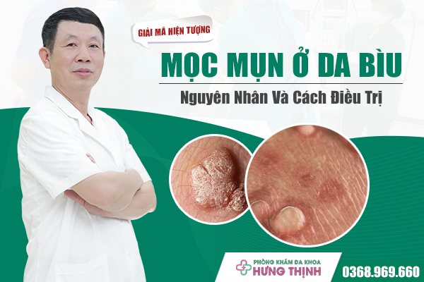 Giải Mã Hiện Tượng Mọc Mụn Ở Da Bìu: Nguyên Nhân Và Cách Điều Trị