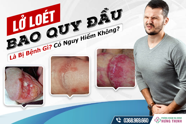 Lở Loét Bao Quy Đầu Có Phải Là Bệnh? Có Nguy Hiểm Không?