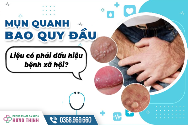 Mụn quanh bao quy đầu- Liệu có phải dấu hiệu bệnh xã hội?