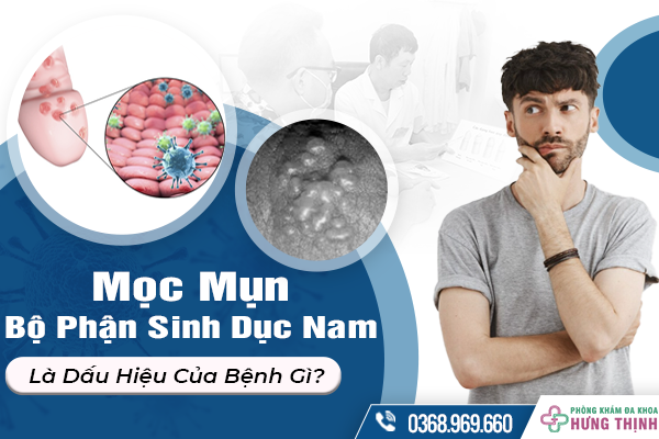 Mọc Mụn Bộ Phận Sinh Dục Nam Là Dấu Hiệu Của Bệnh Gì? 