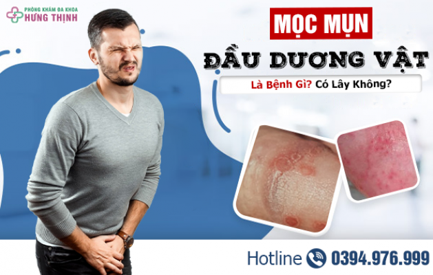 Mọc Mụn Đầu Dương Vật Là Bệnh Gì? Có Lây Không?