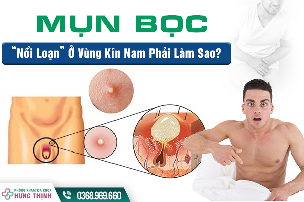 Mụn Bọc “Nổi Loạn” Ở Vùng Kín Nam Giới Phải Làm Sao?