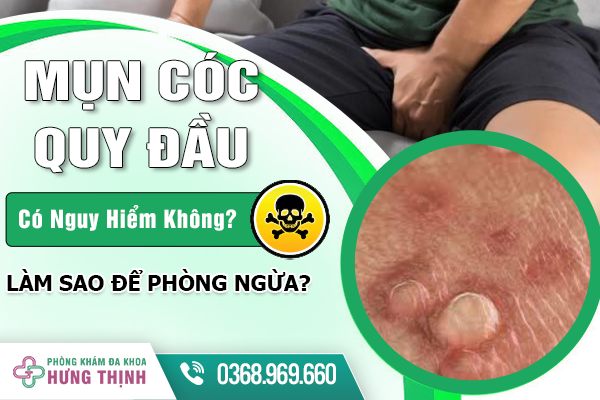 Mụn Cóc Ở Quy Đầu Có Nguy Hiểm Không? Làm Sao Để Phòng Ngừa?